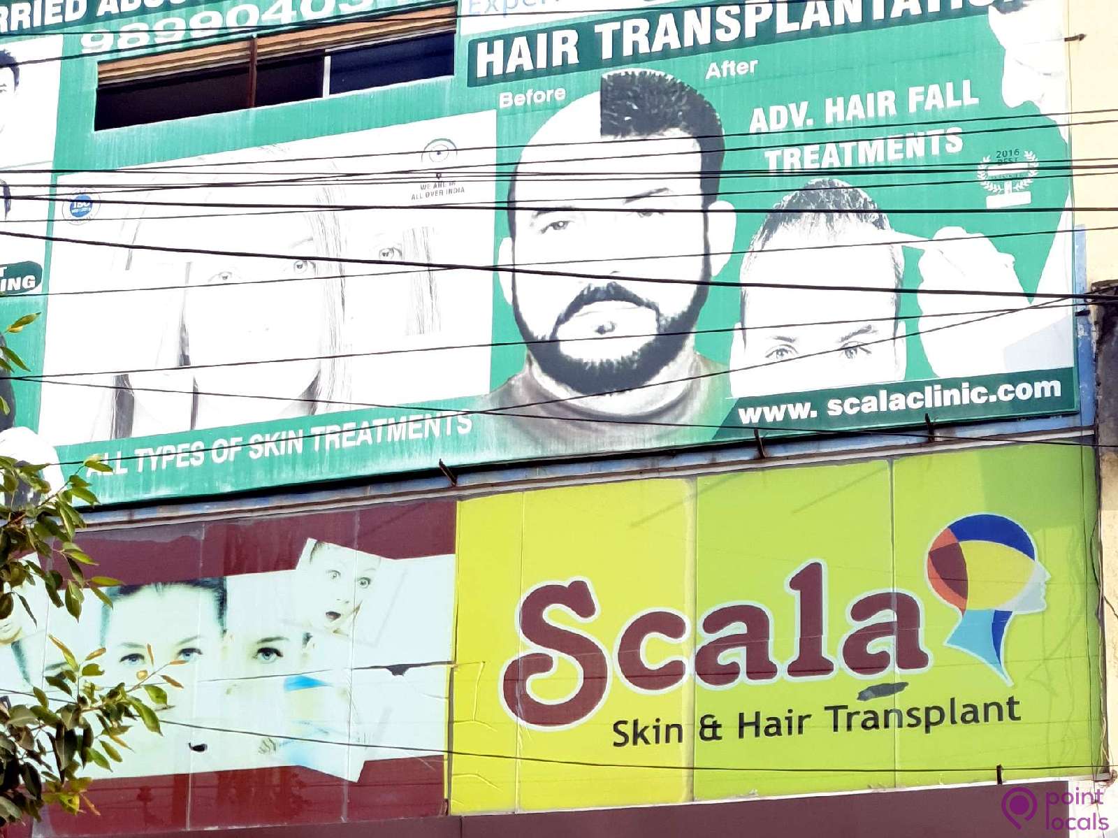 Can We use body hair for hair Transplantation  Scala Skin care  Hyderabad   YouTube