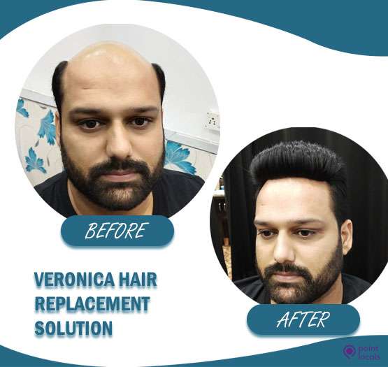 Veronica Hair Replacement Solution - Cosmetic Surgery Clinic in , |  Pointlocals